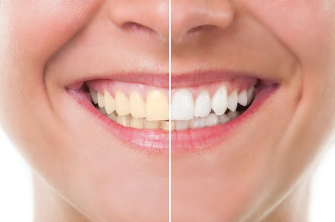 teeth whitening comparison model