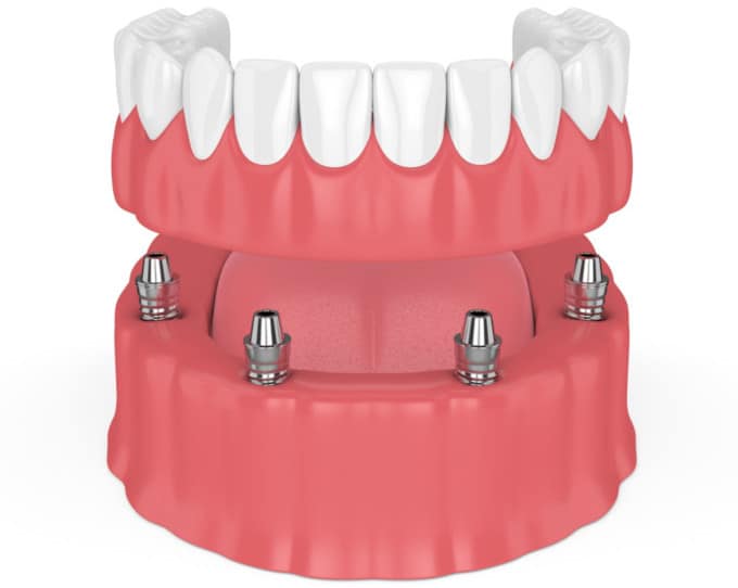 all 4 dental implant work